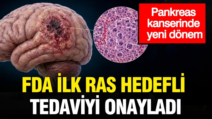 Pankreas kanserinde yeni dönem: FDA ilk RAS hedefli tedaviyi onayladı